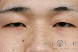 眼瞼挙筋前転法-谷医師