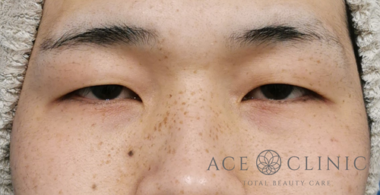 眼瞼挙筋前転法-谷医師